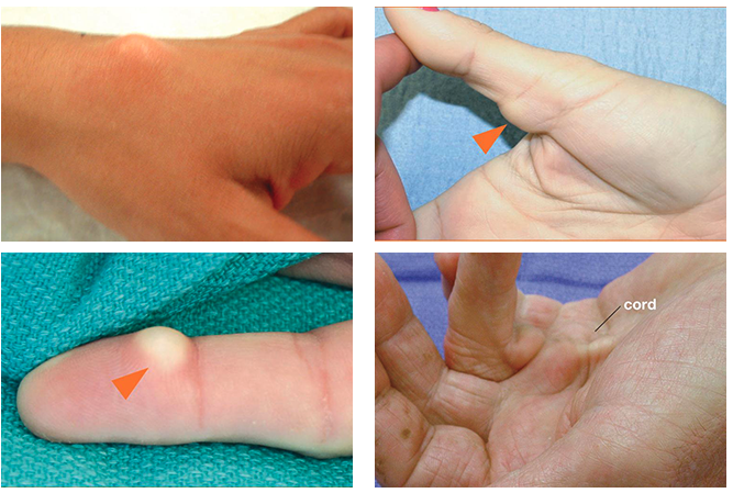 Vanessa Gabrovsky Cu  llar MD Inc | Orthopaedic Hand   Wrist Surgery, APIC  A2M  Anti-Inflammatory Injections and Whole Body Health  Supplements